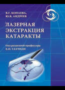 Лазерная экстракция катаракты