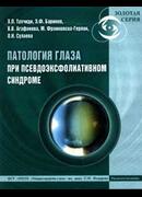 Патология глаза при псевдоэксфолиативном синдроме
