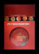 Ретиношизис. Этиопатогенез, диагностика, клиника, лечение