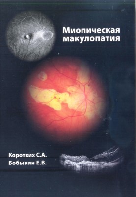 Миопическая макулопатия