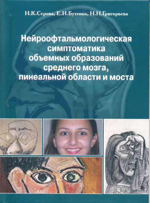 Нейроофтальмологическая симптоматика объемных образований среднего мозга, пинеальной области и моста