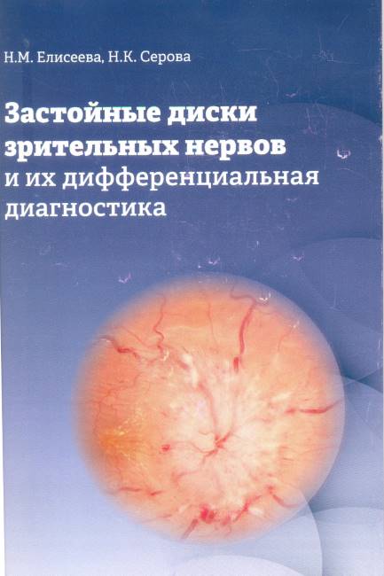 Застойные диски зрительных нервов и их дифференциальная диагностика