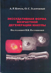 Экссудативная форма возрастной дегенерации макулы