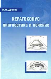 Кератоконус: диагностика и лечение