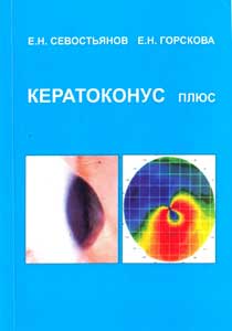 Кератоконус плюс