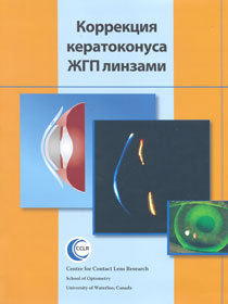 Коррекция кератоконуса ЖГП линзами