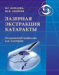 Лазерная экстракция катаракты